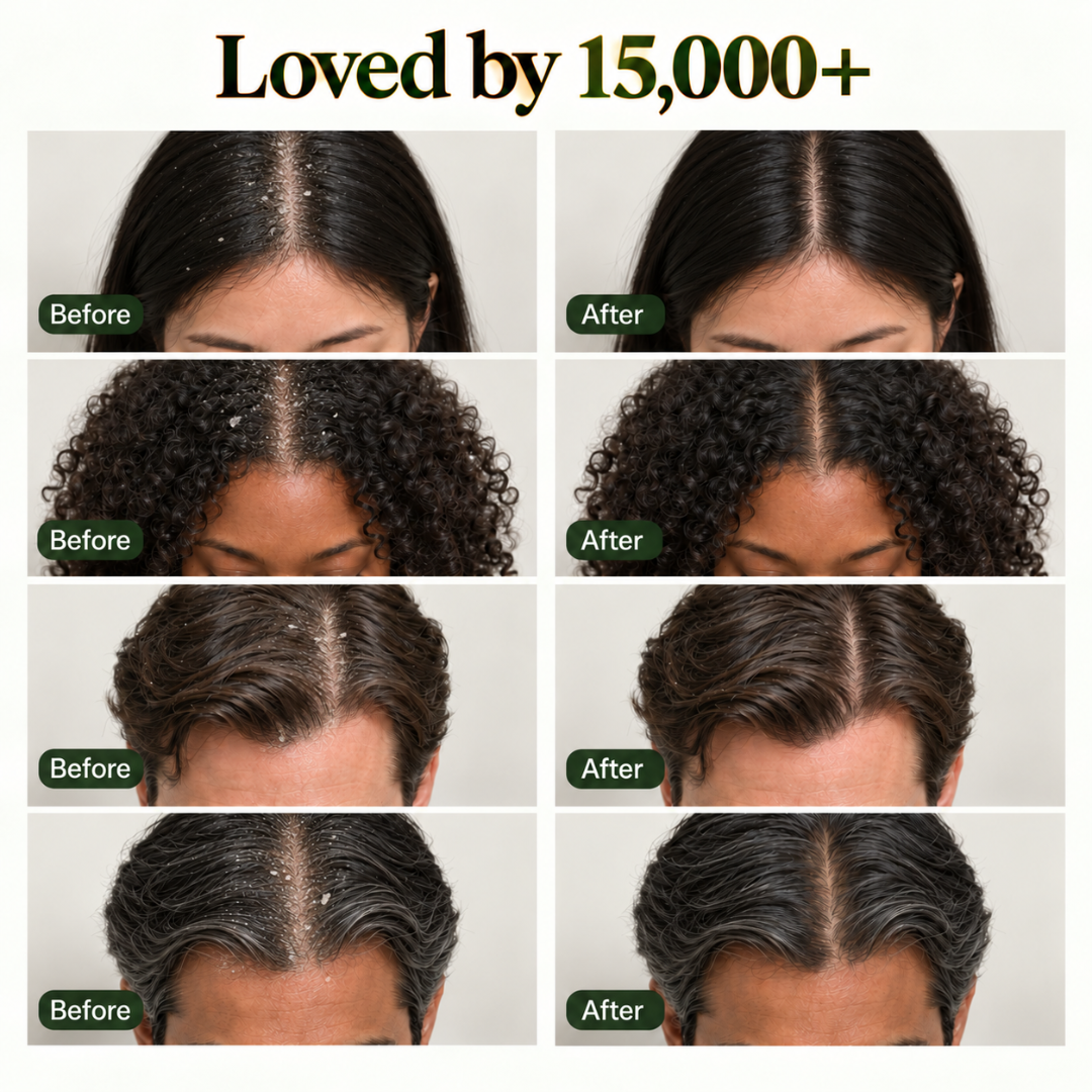 BINURA™ Anti Dandruff Shampoo Bar